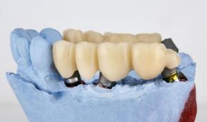 Prótesis Dentales Fijas y Removibles: ¿Cuál Elegir?